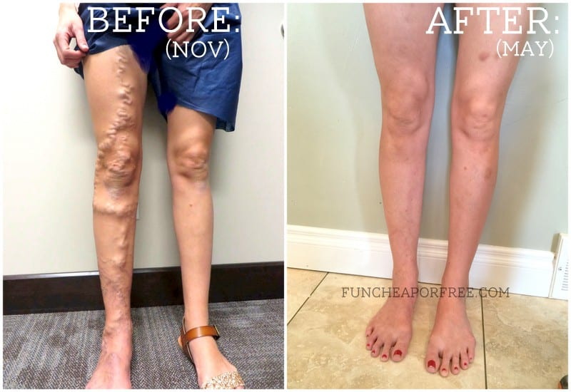 My Varicose Veins Story: ALL Your Questions Answered + Video